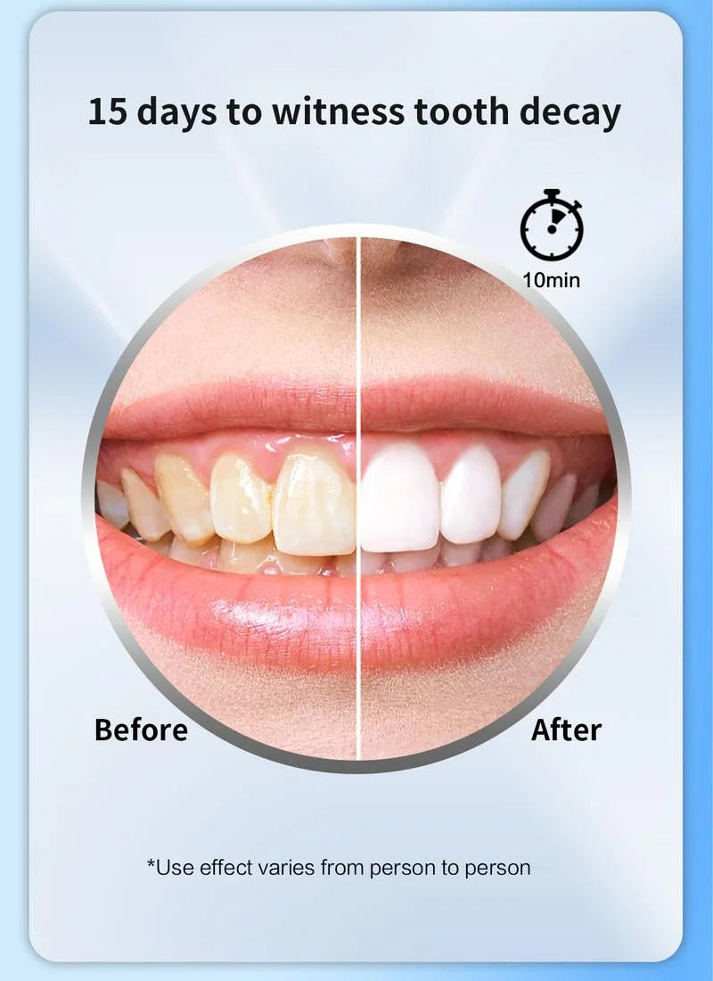 DENTPRO! Kit de blanqueamiento dental