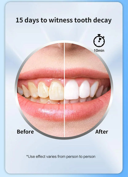 DENTPRO! Kit de blanqueamiento dental